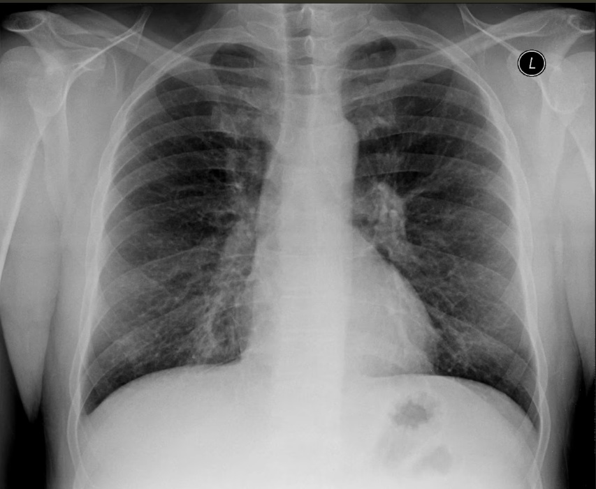 Radiografie toracică brută